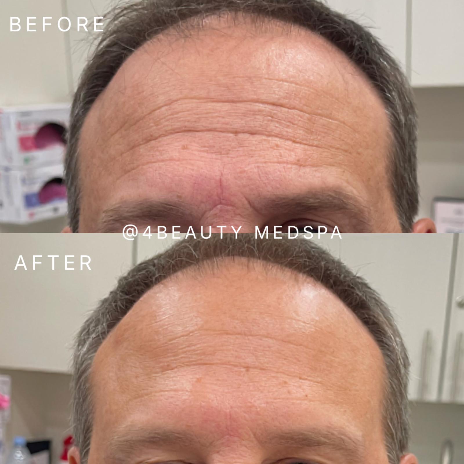 Before-and-after photo of a woman's profile, showing reduced wrinkles and tightened skin after a cosmetic treatment.