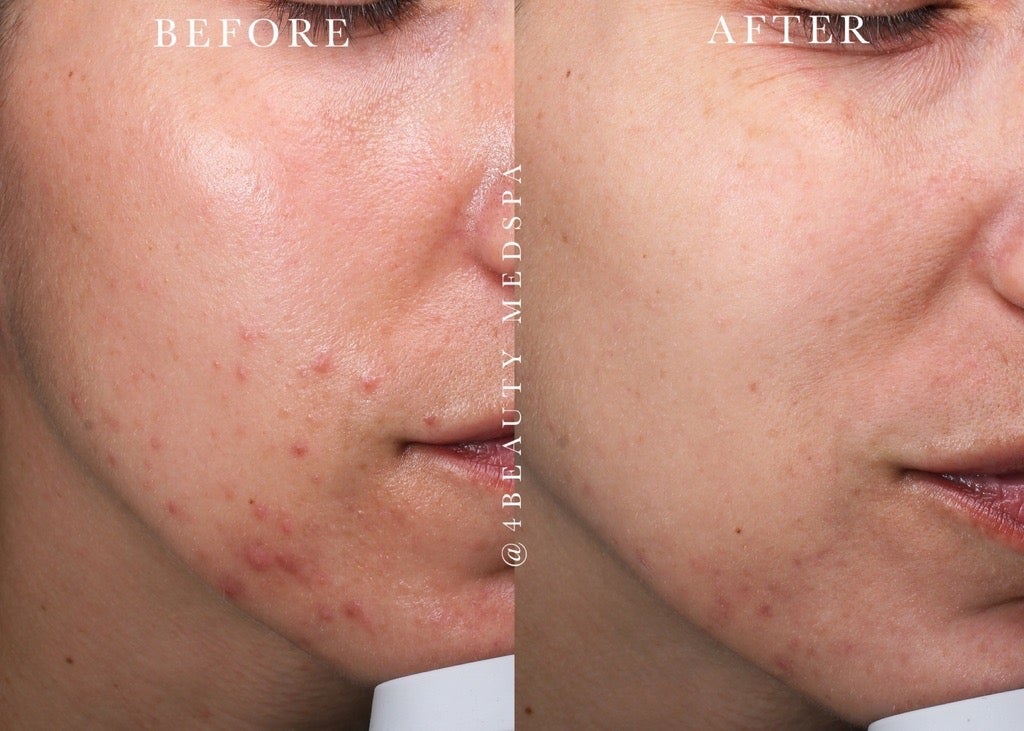 Aerolase® Treatment