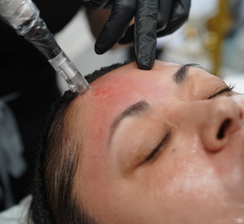 Microneedling Treatment