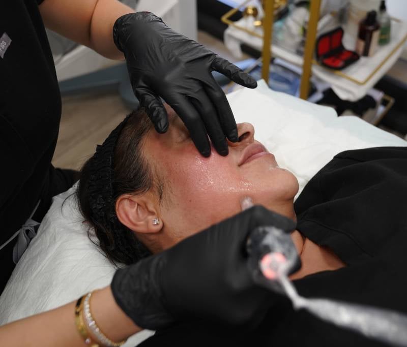 Microneedling Treatment