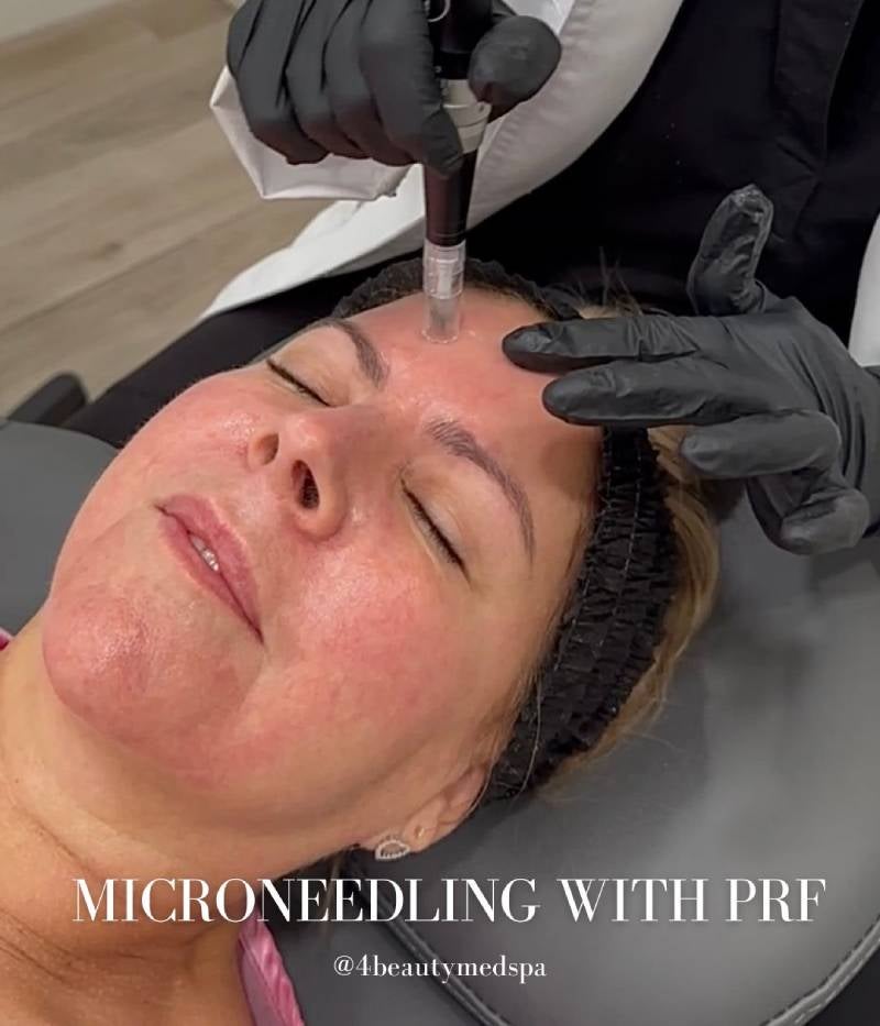 Microneedling Treatment