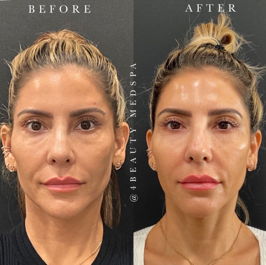 Before and after photos show a woman's jawline before aesthetic treatment (left) and after for a more defined look (right).