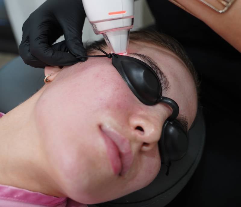 woman getting a lutronic procedure done