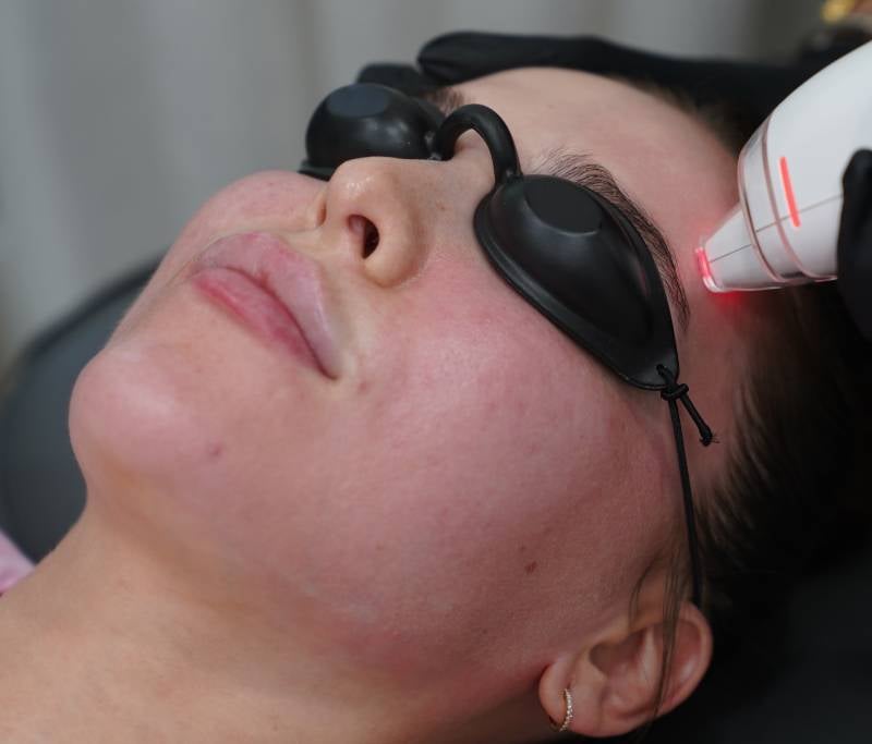 woman getting a lutronic procedure done