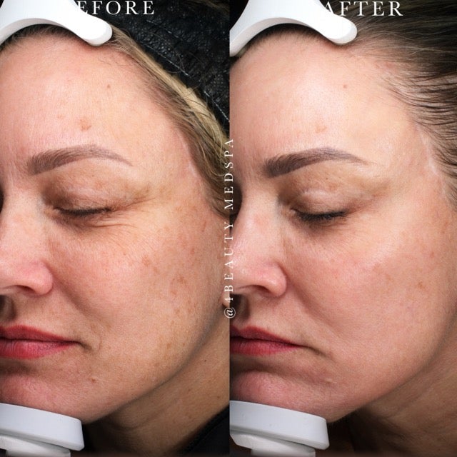 Chemical Peel