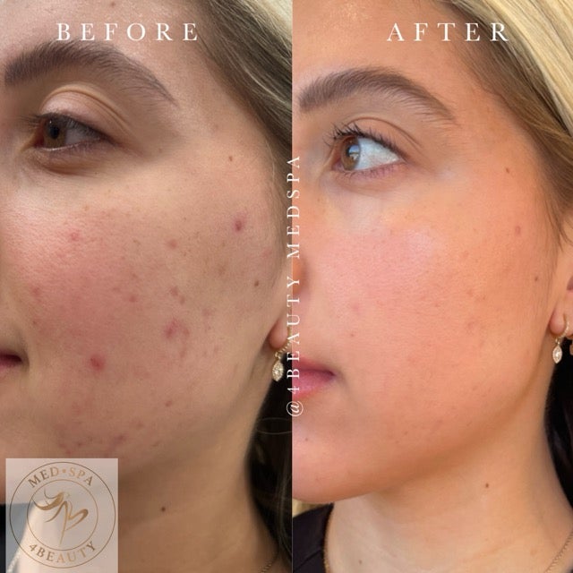 Chemical Peel