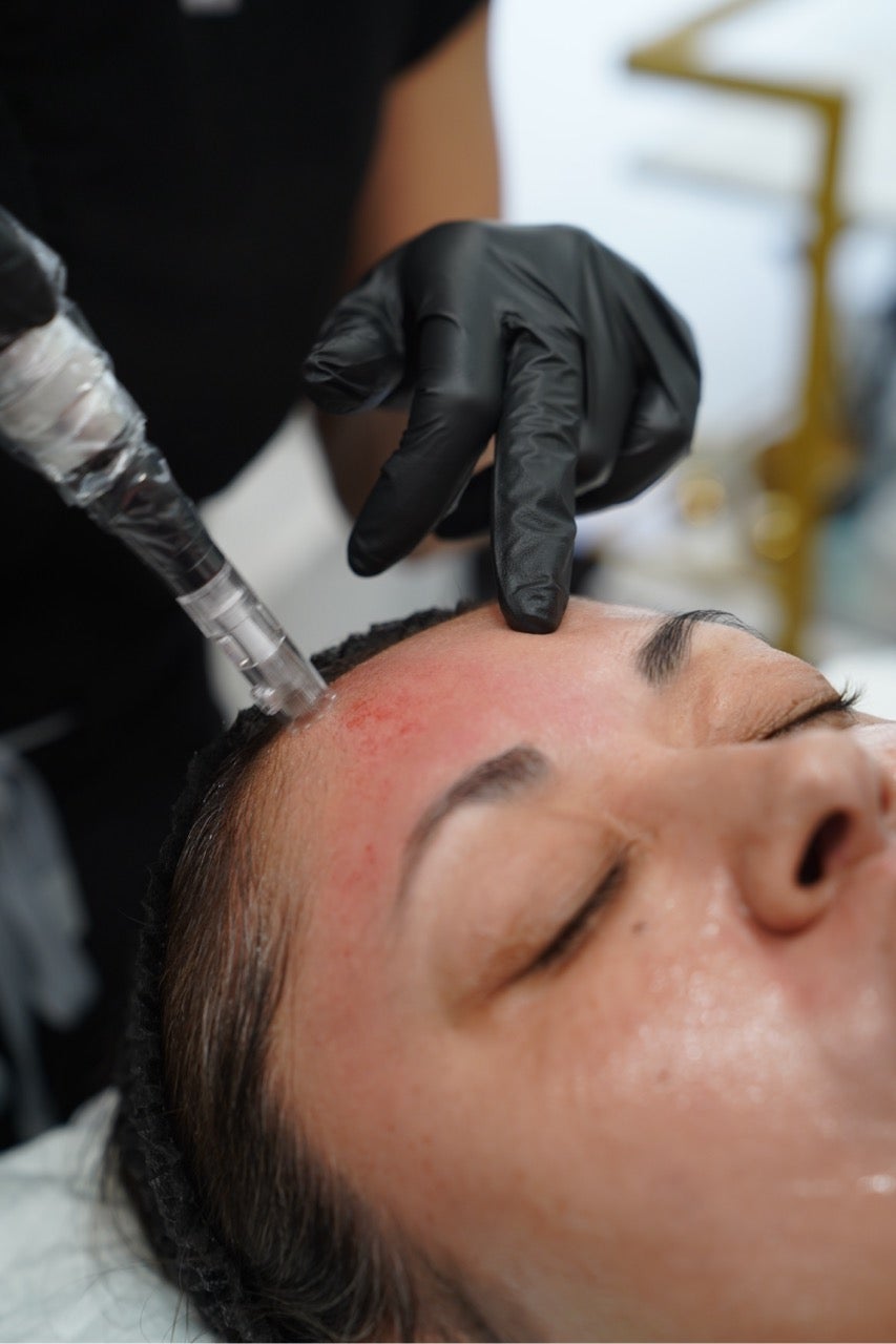 A woman getting microneedling procedure done