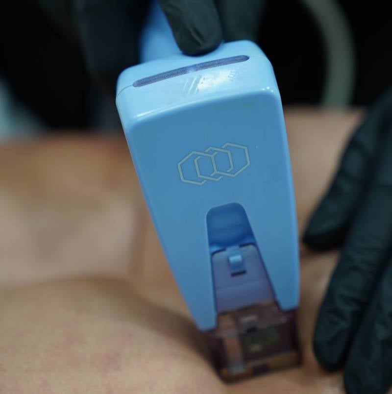 What Are the Aesthetic Benefits of Morpheus8 Skin Tightening?