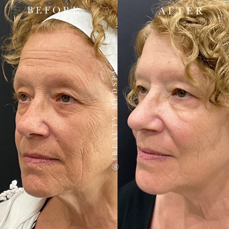 Morpheus8 Skin Tightening