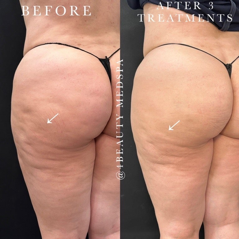 Morpheus8 skin treatment