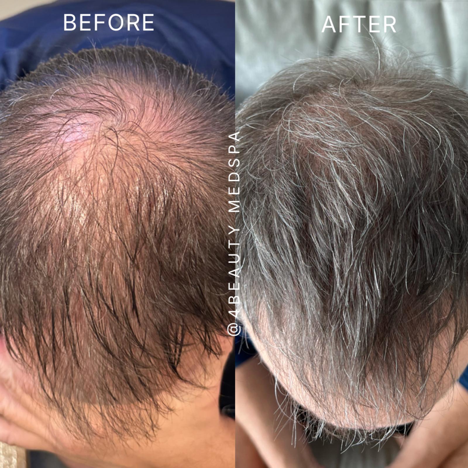 Before and after hair restoration