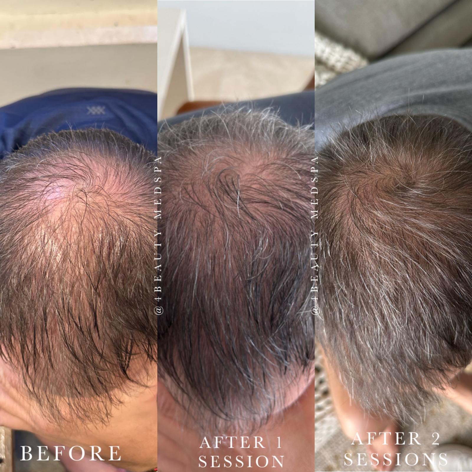 Before and after hair restoration