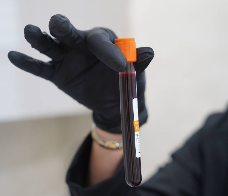 PRP Treatment