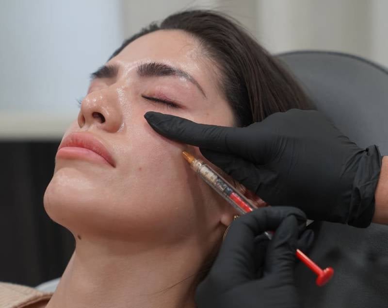 Restylane Injections