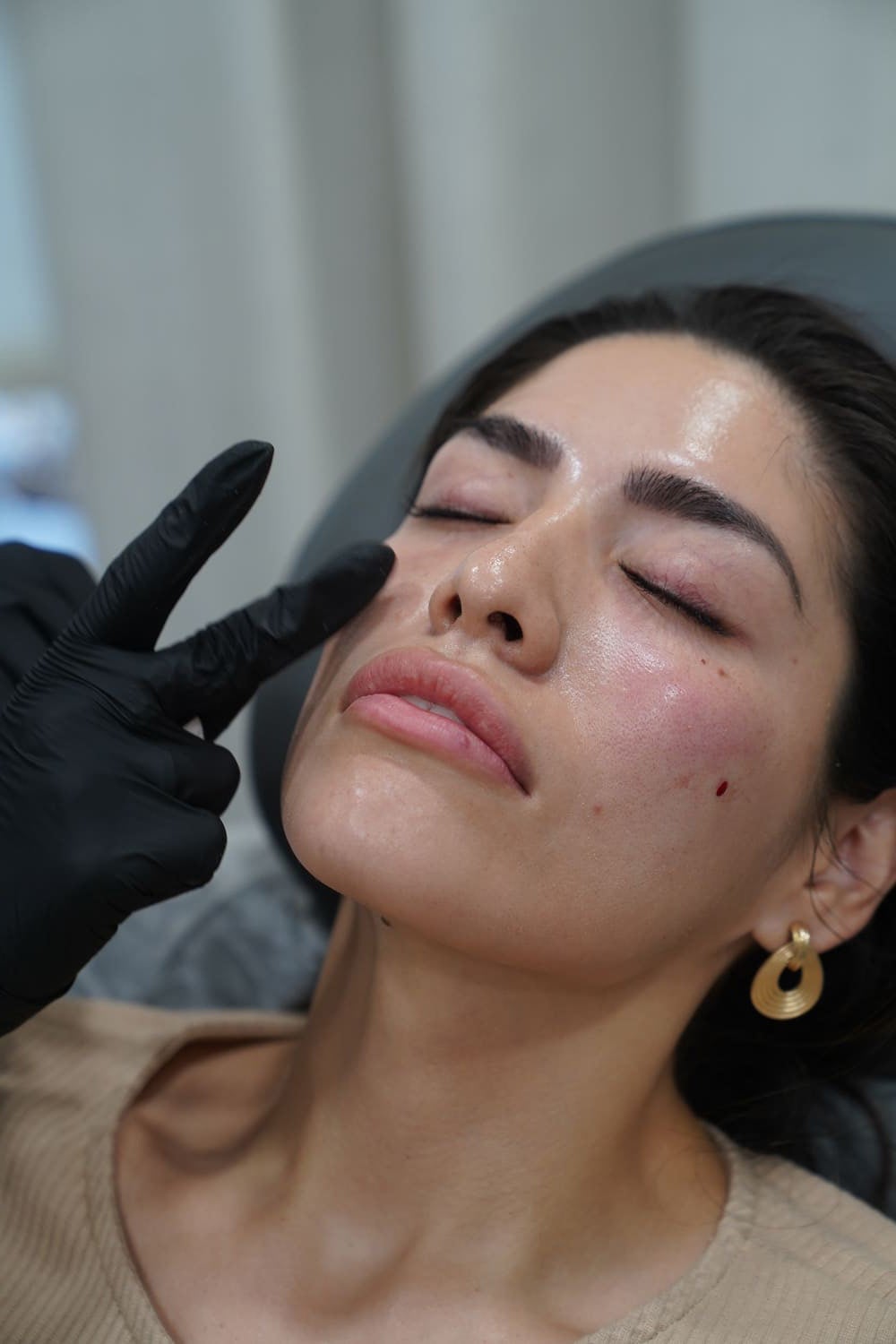 Sculptra® Pros and Cons