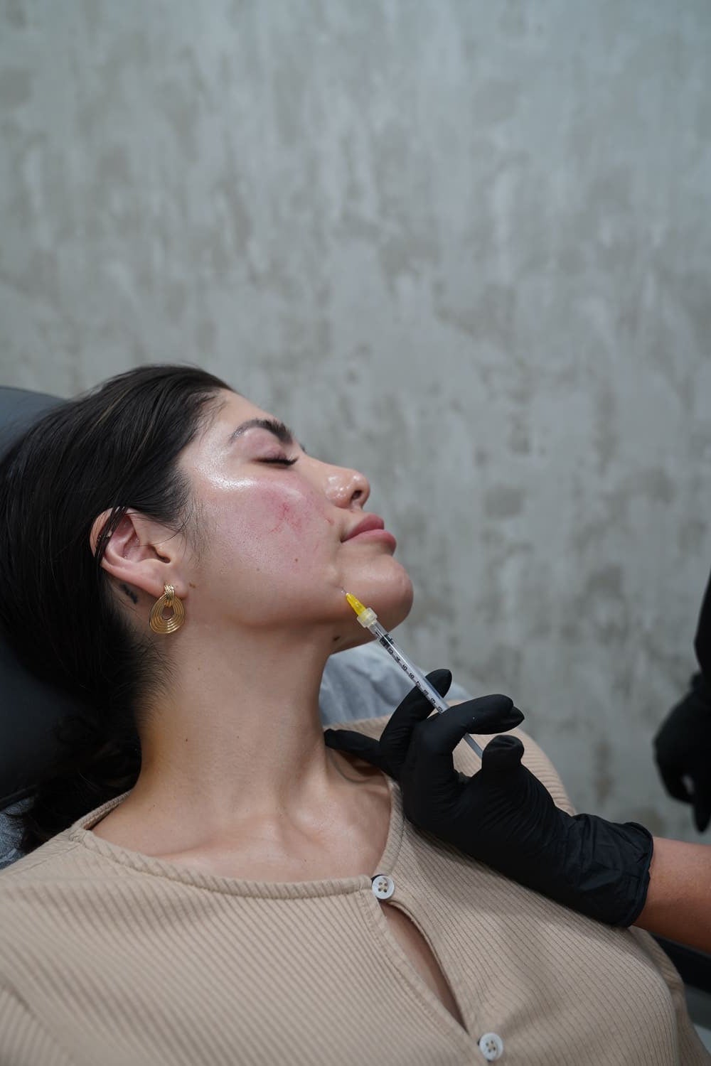 Where Can Sculptra® Be Injected?