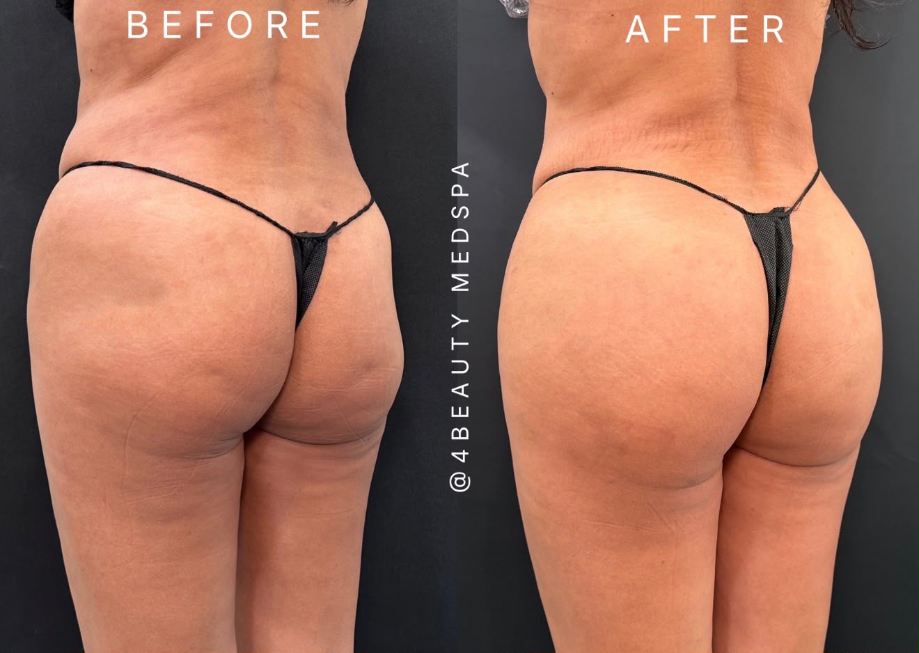Rear view of a person's buttocks and upper thighs before, immediately after, and three weeks after a gluteal aesthetic procedure.