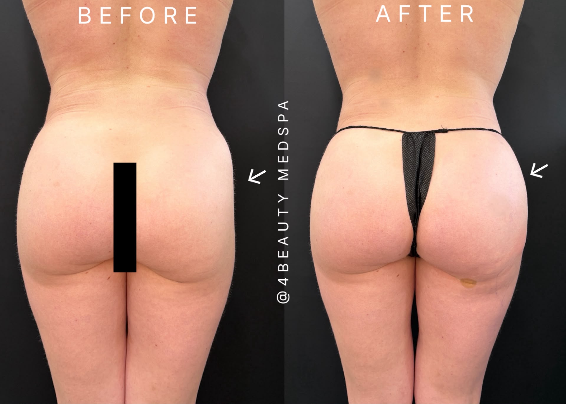 before and after nonsurgical butt lift - patient 1