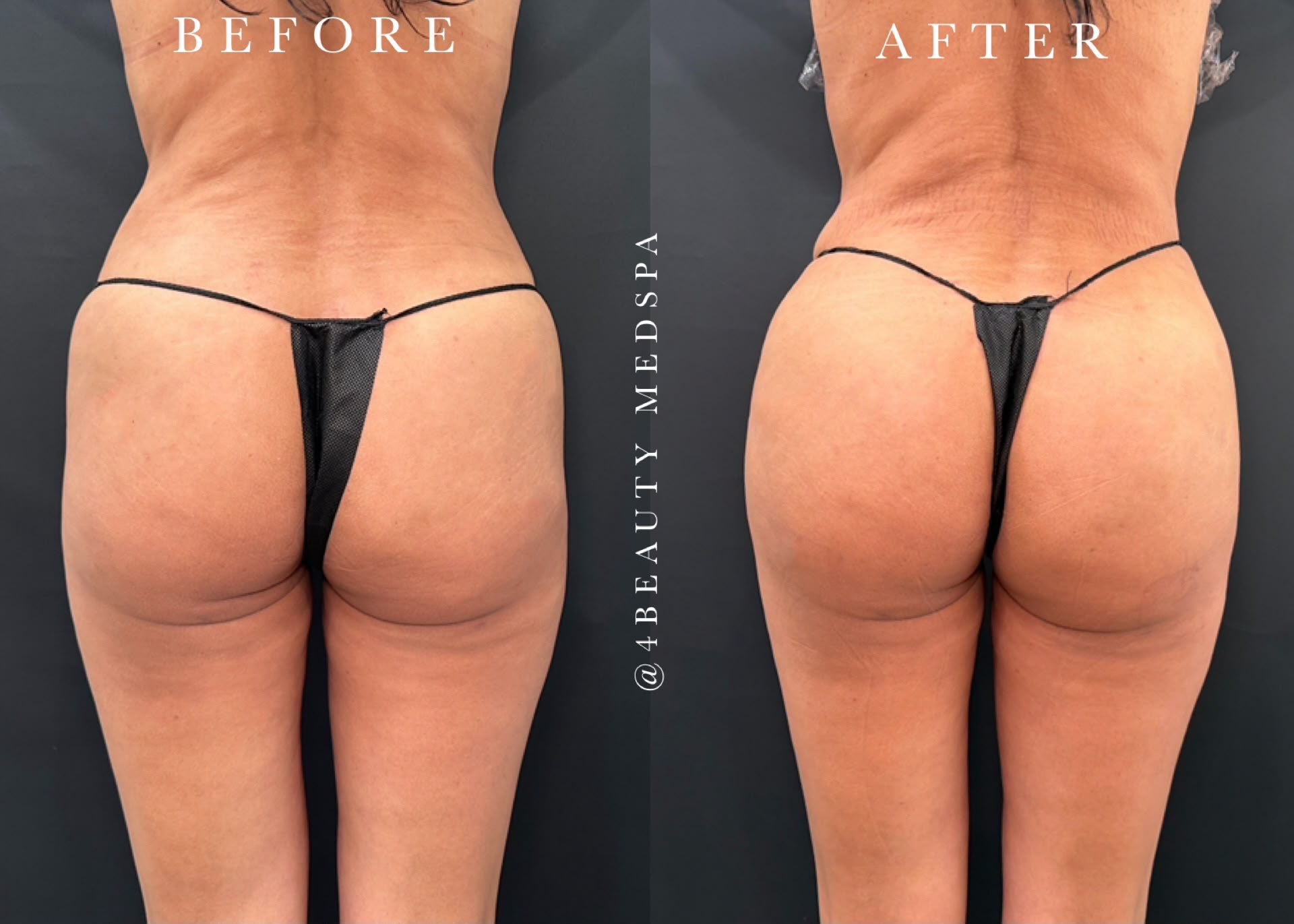 before and after nonsurgical butt lift - patient 1