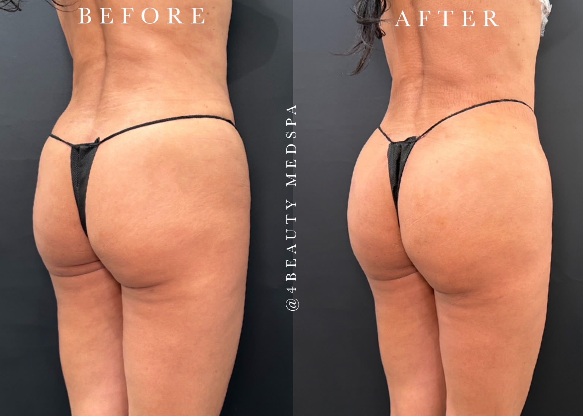 Non-surgical BBL