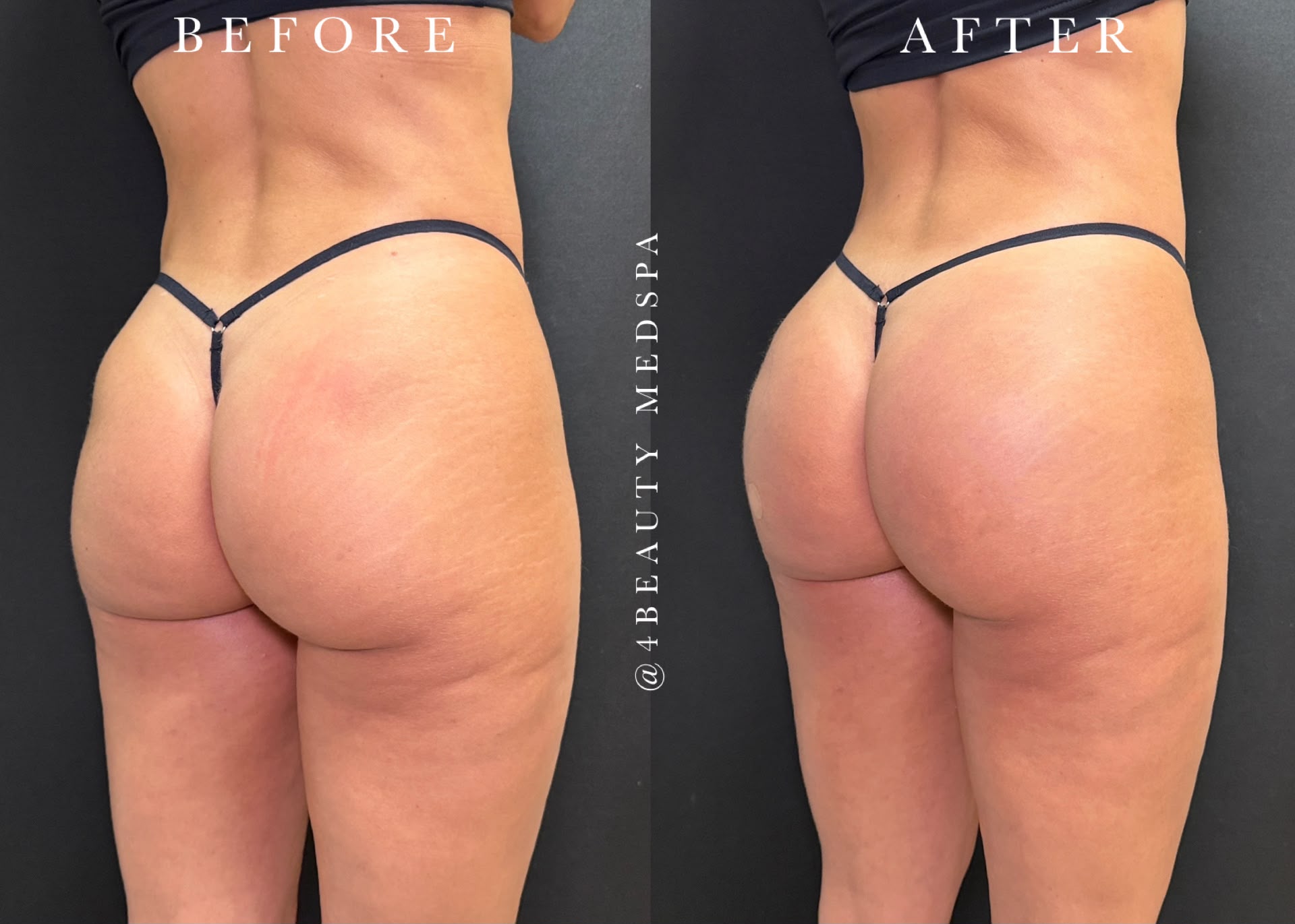 Non-surgical BBL