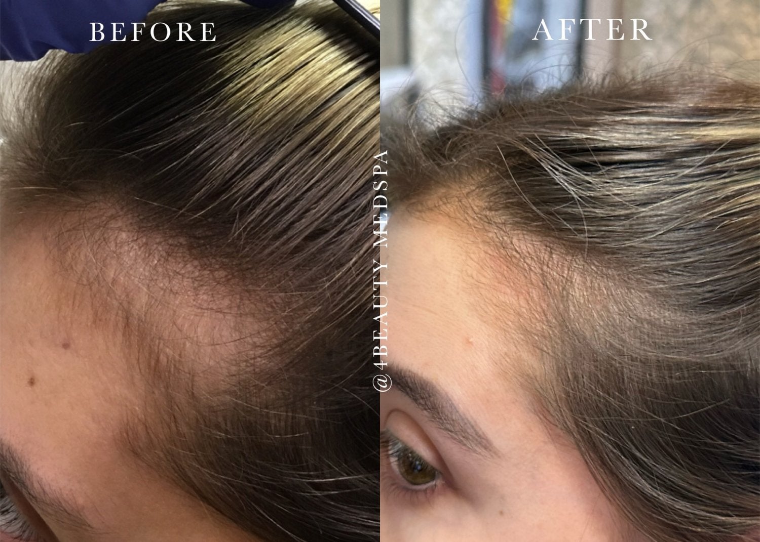 Before and after Hair restoration