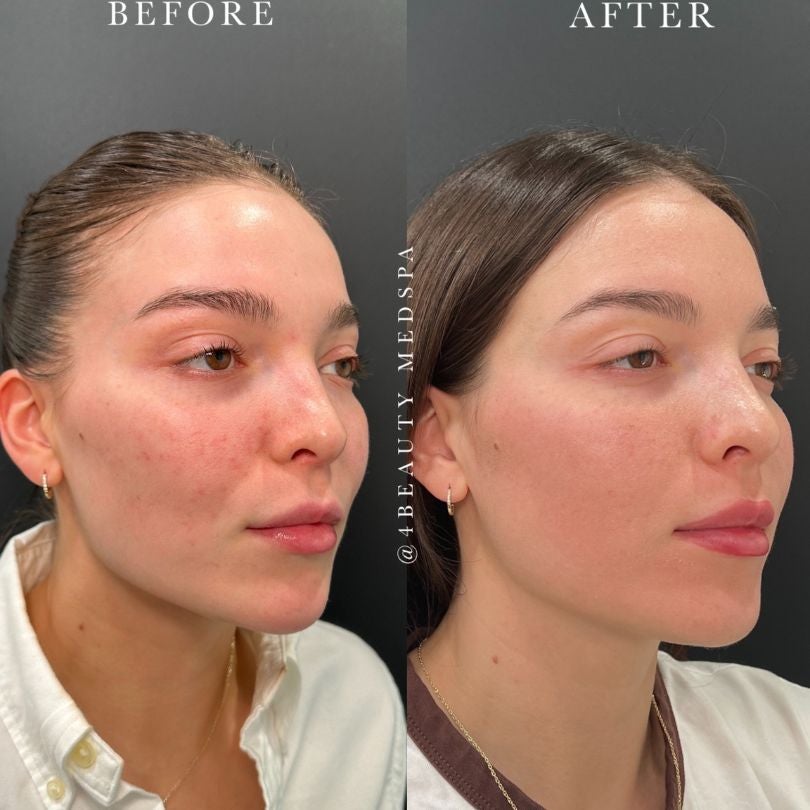 Before and after photos of a Latina woman, showing reduced dark circles and more defined lips and facial contours.