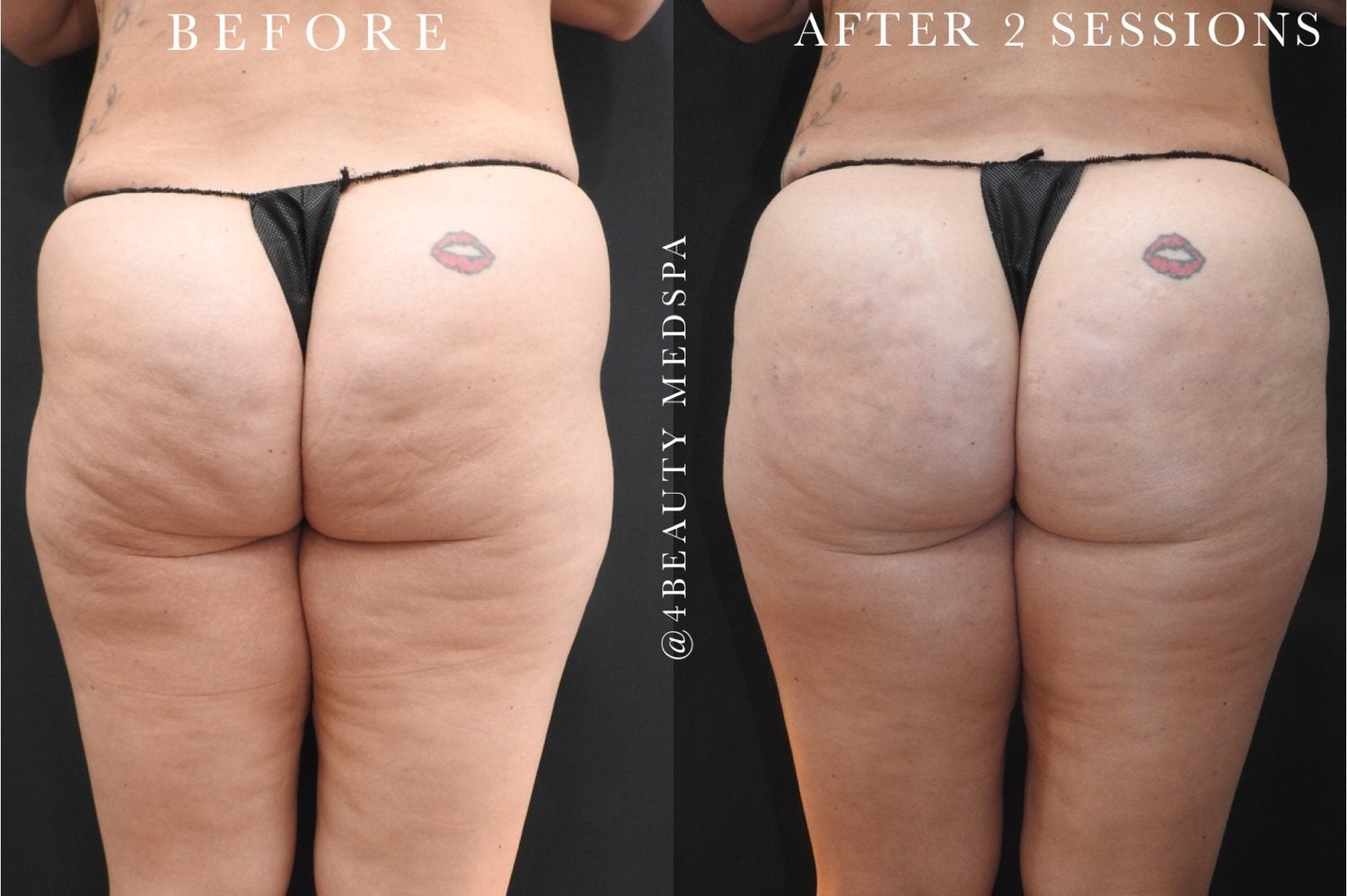 before and after nonsurgical butt lift - patient 1