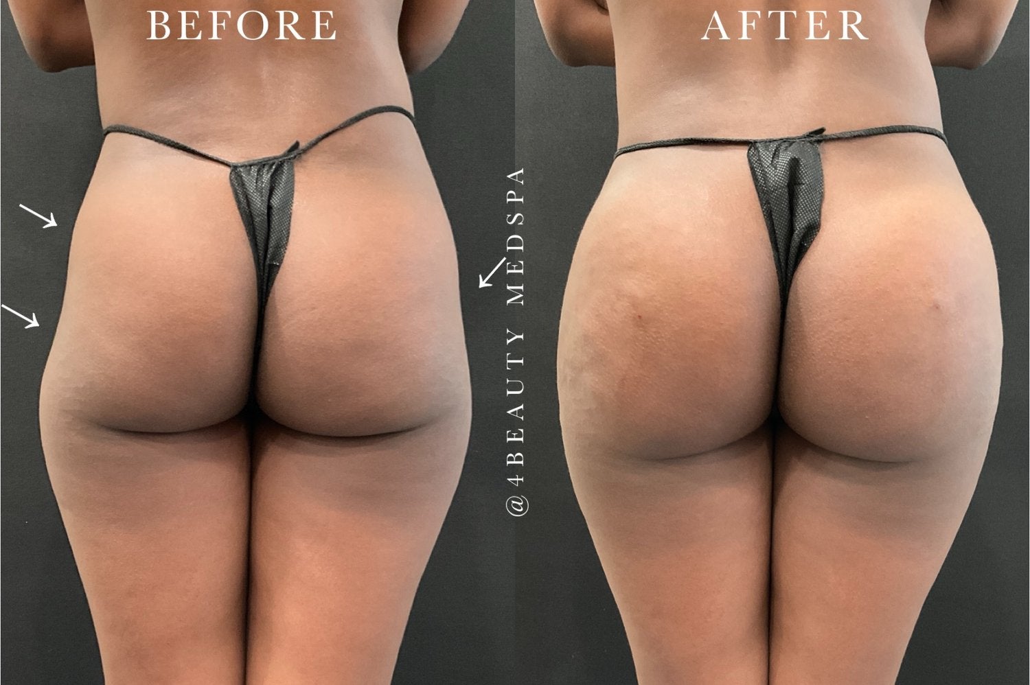 before and after nonsurgical butt lift - patient 2