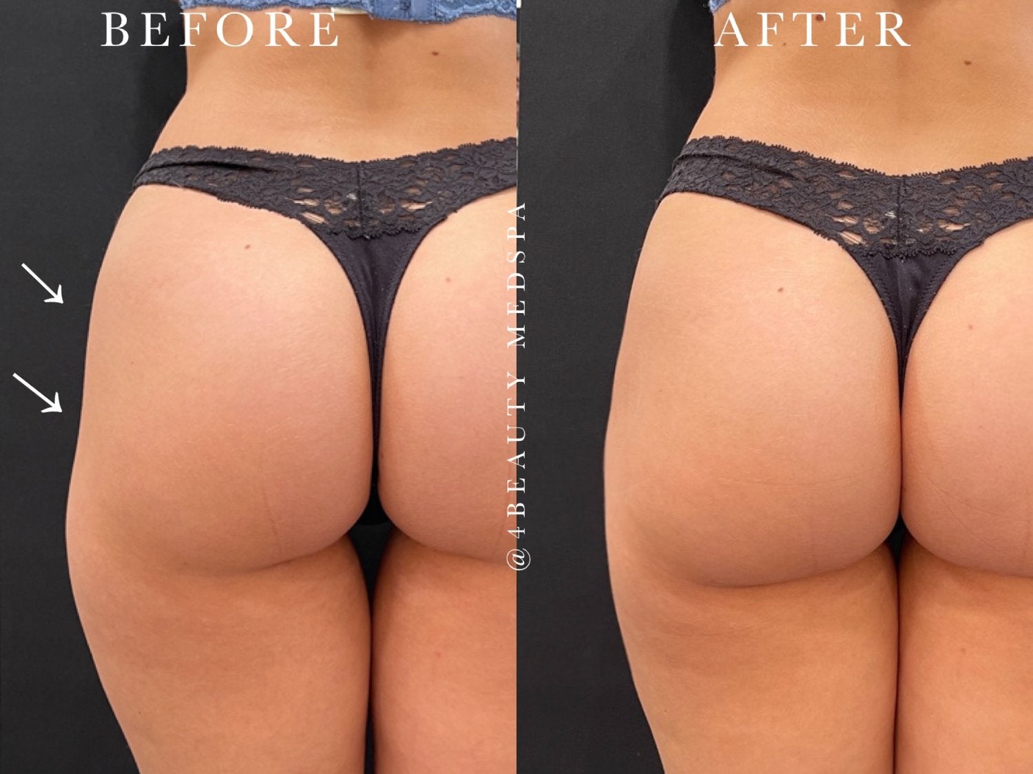 before and after nonsurgical butt lift - patient 3