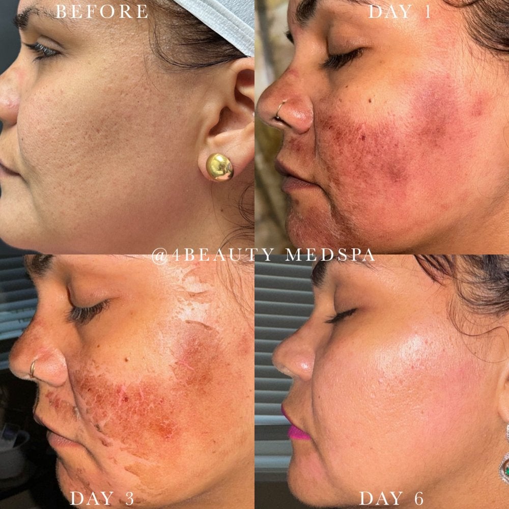 Four side-profile photos showing a woman's face before, day 1, day 3, and day 6 of a skin treatment.