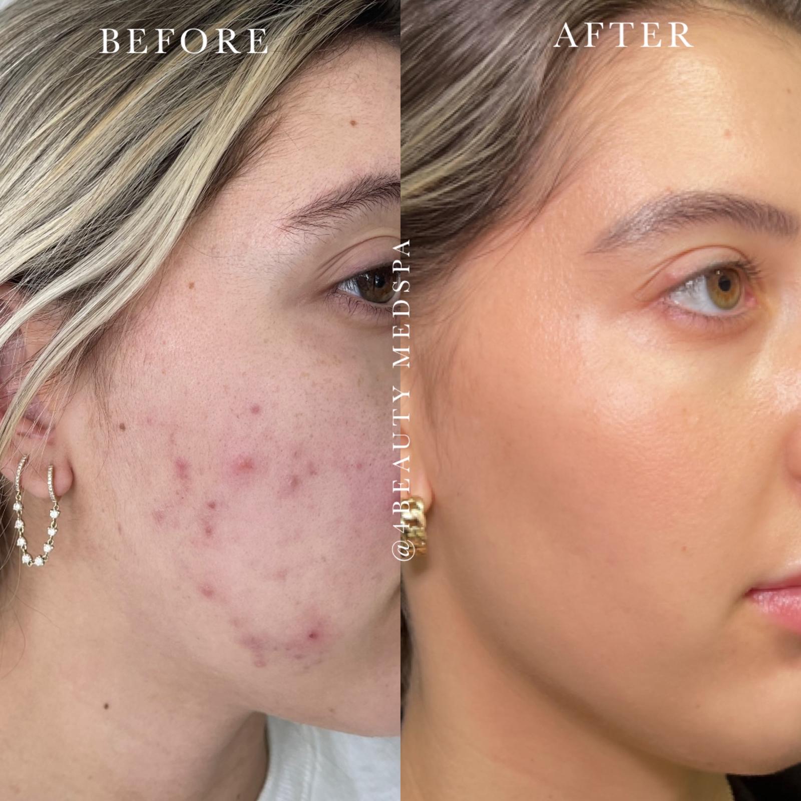 Before and after image showing a woman's face, with acne on her before skin, and clear, glowing skin in after.