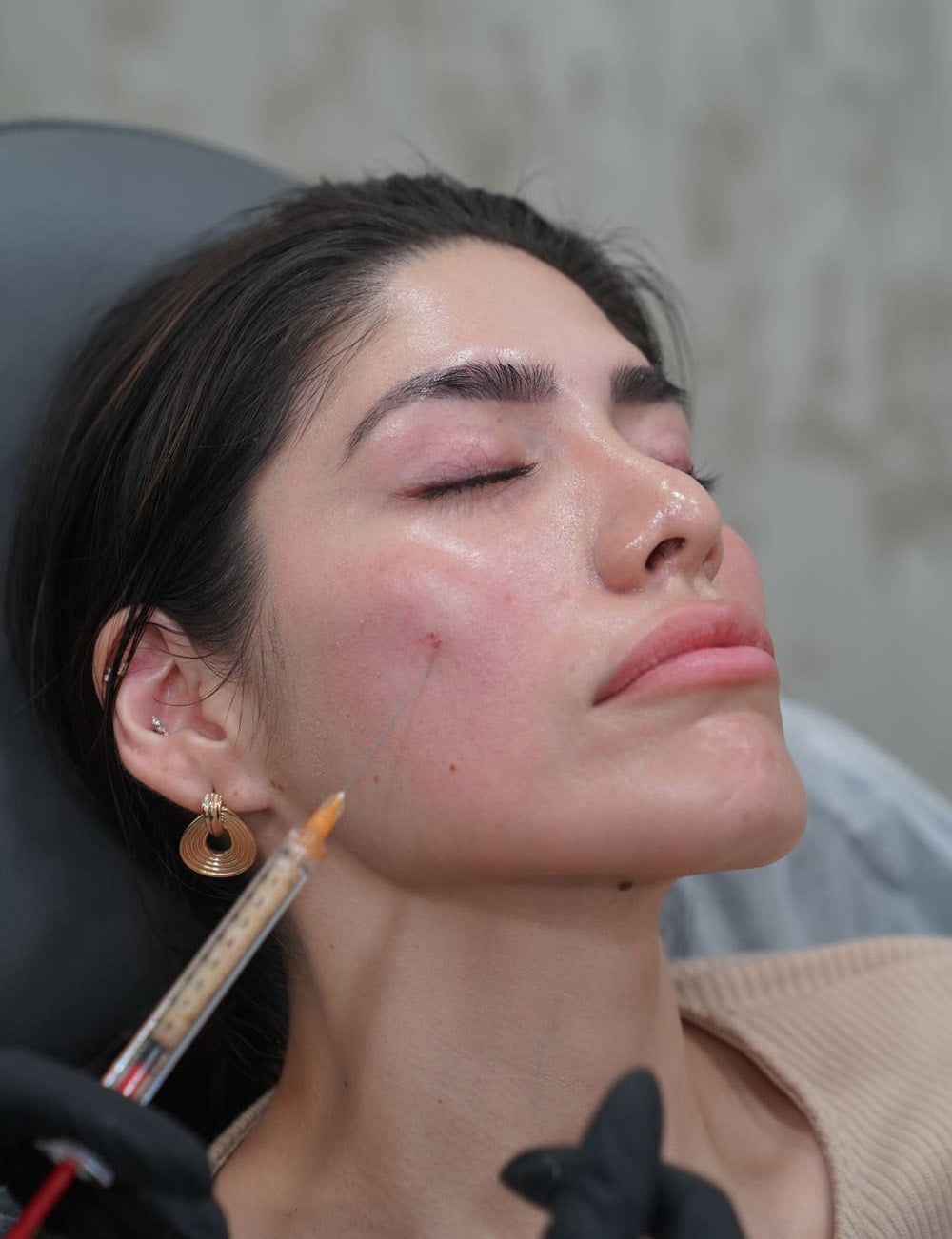 A woman receiving facial thread lifts, with a needle entering her cheek and thread visible near the injection site.