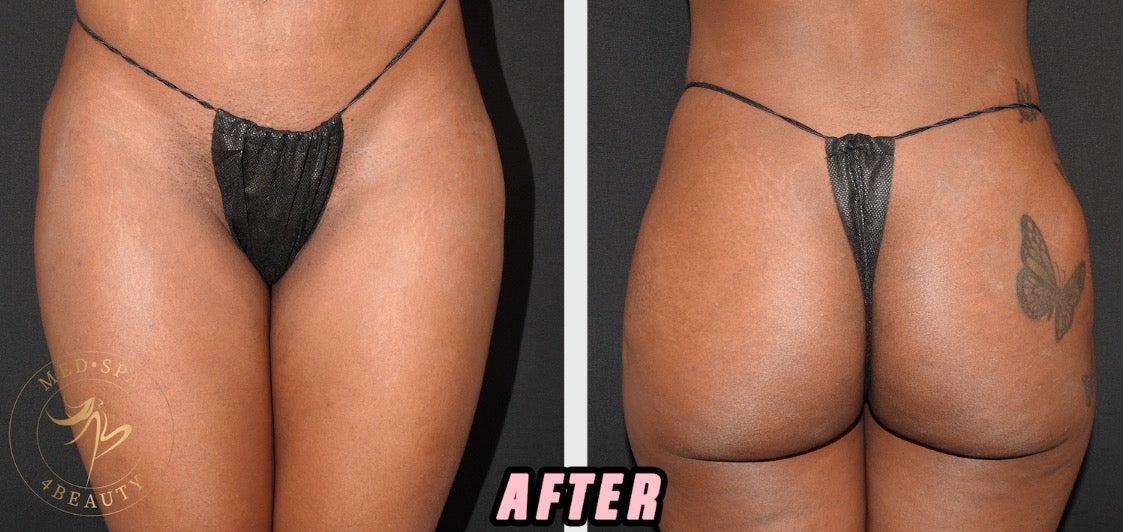 Sculptra Hip Dips After