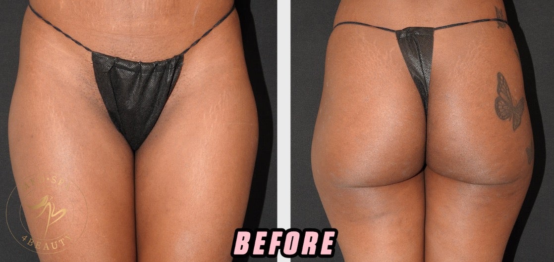 Hate Your Hip Dips? Here Are Your Options