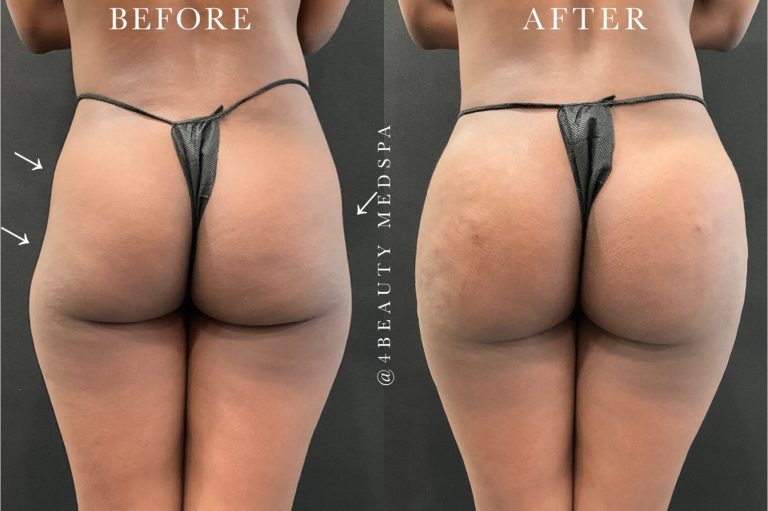 before and after result of a sculptra hip-drip