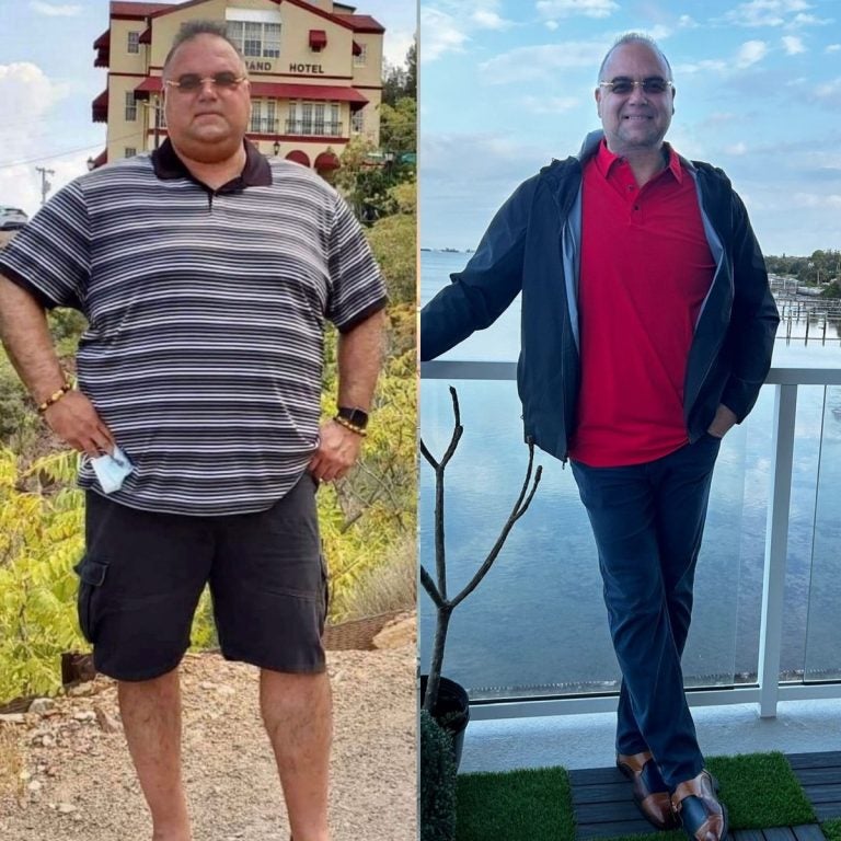 male patient: before and after Weight Loss treatment